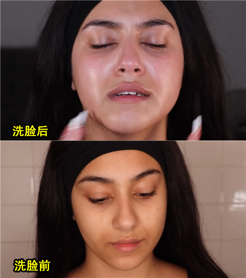 居然有人对水过敏 那该怎么洗澡、喝水、上厕所？