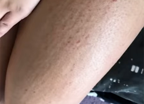 居然有人对水过敏 那该怎么洗澡、喝水、上厕所？