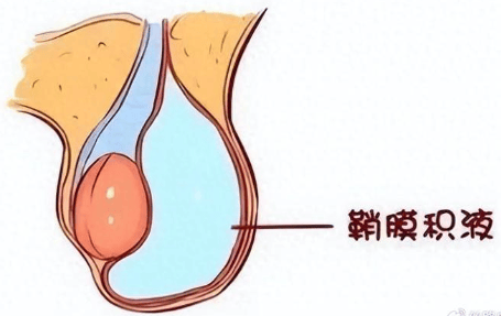 “蛋蛋”一大一小，鼓个大包？小小手术，解除大大负担