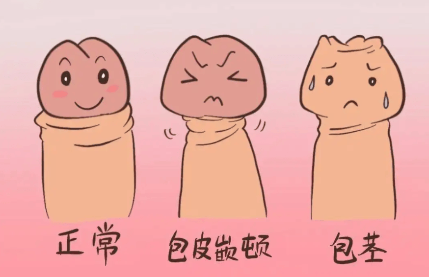 这四种情况需要做包皮手术，请对号入座 